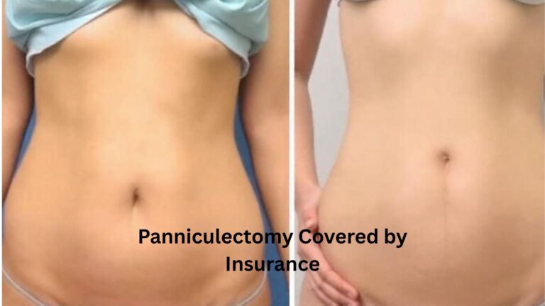 Panniculectomy Covered by Insurance