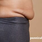 Panniculectomy Covered By Insurance? Discover Your Options Now!