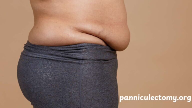 Pannus Stomach: Understanding Causes, Relief, and Treatment Options