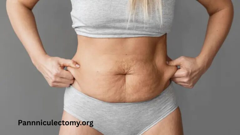How to get a panniculectomy covered by insurance